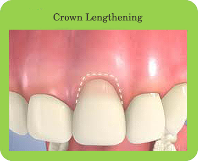 Crown Lengthening